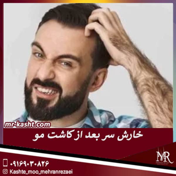 خارش سر بعد از کاشت مو