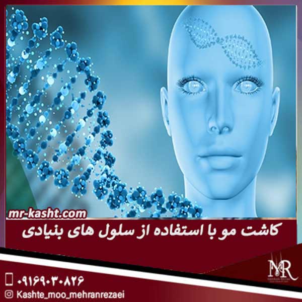 کاشت مو با استفاده از سلول های بنیادی