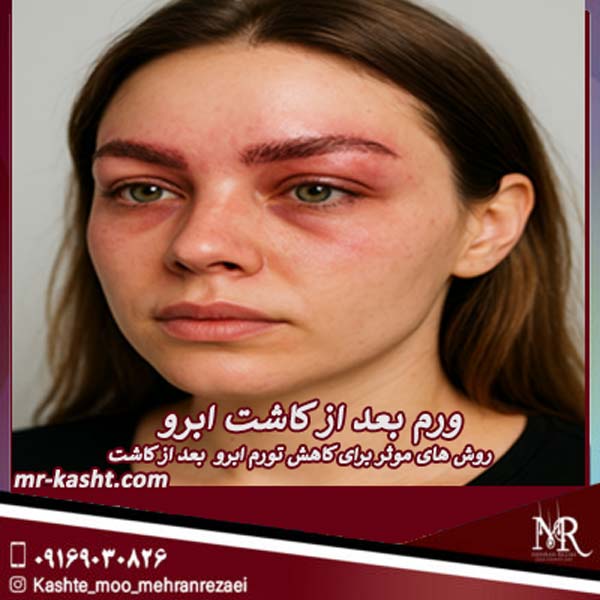 ورم بعد از کاشت ابرو