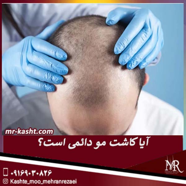 آیا کاشت مو دائمی است؟