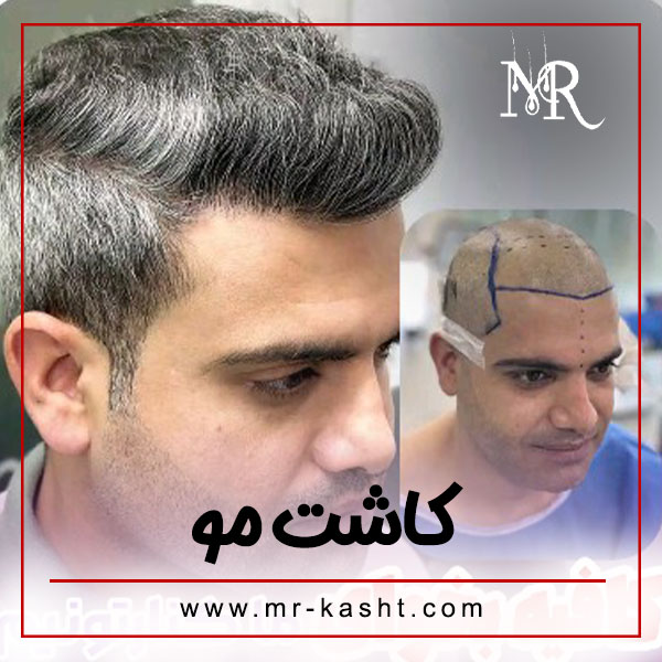 کاشت مو در شیراز + تیم تخصصی مهران رضایی