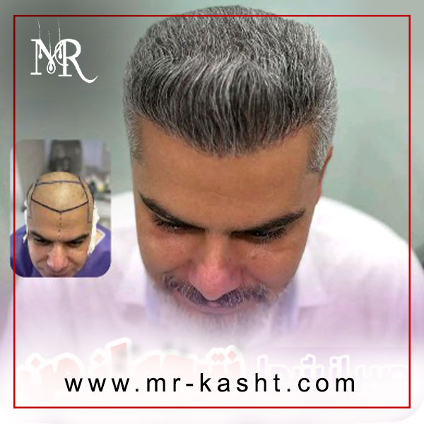 کاشت مو در شیراز + تیم تخصصی مهران رضایی