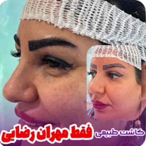 eyebrow-transplant