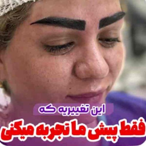 eyebrow-transplant1