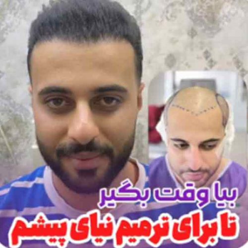 hair-transplant11