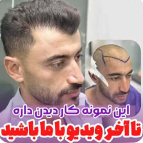 hair-transplant12