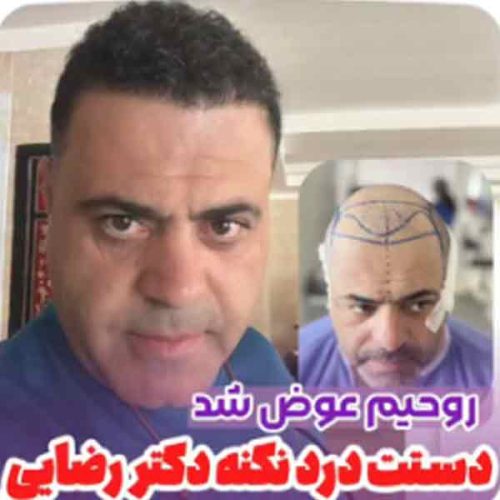 hair-transplant13