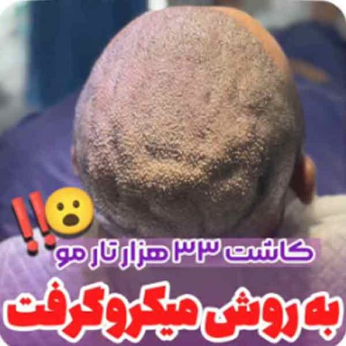 hair-transplant14