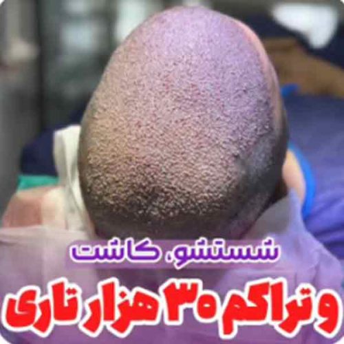 hair-transplant15