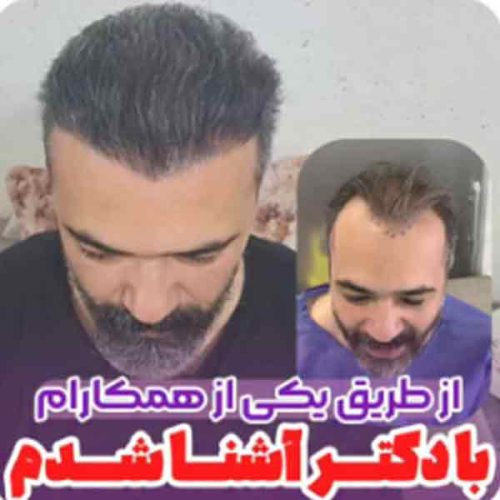 hair-transplant18