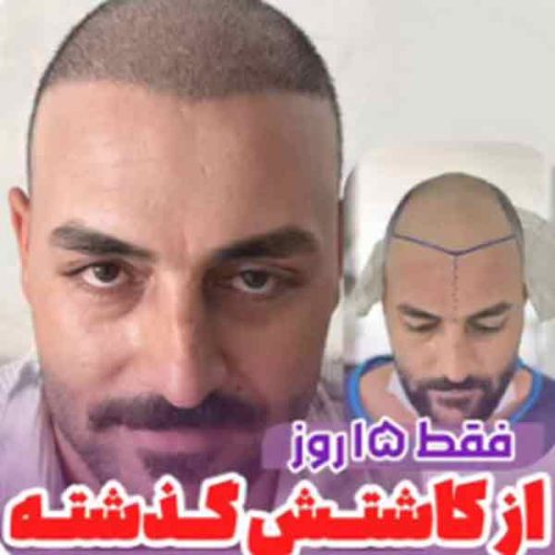 hair-transplant19
