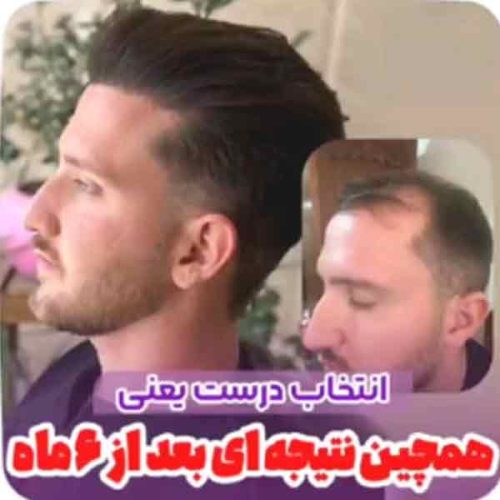 hair-transplant21