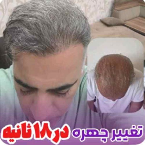 hair-transplant23