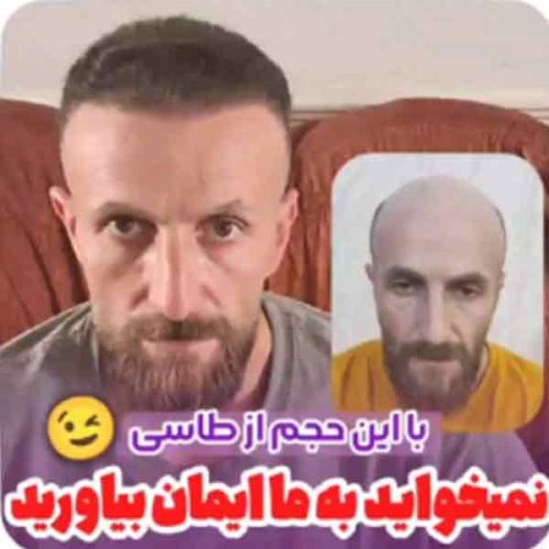 hair-transplant24