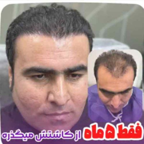 hair-transplant4