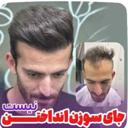 hair-transplant7