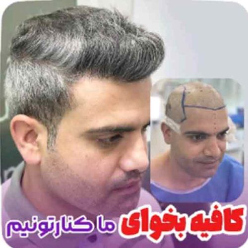 hair-transplant8