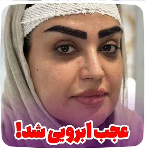 کاشت-ابرو-8
