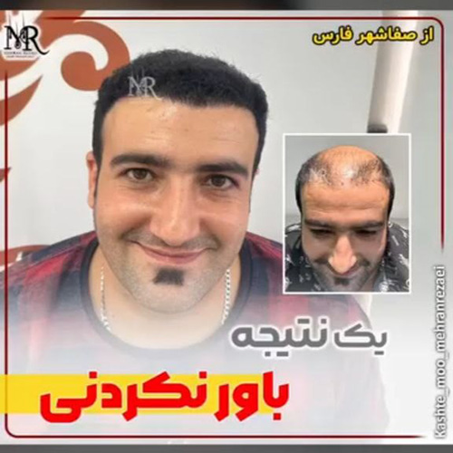 کاشت-مو-34