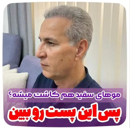 کاشت-مو-38 (1)