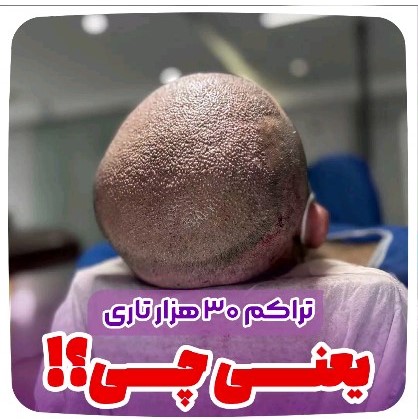 کاشت-مو-41