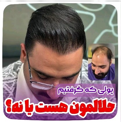کاشت-مو-42