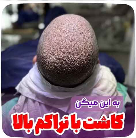 کاشت-مو-43