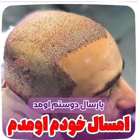 کاشت-مو-44