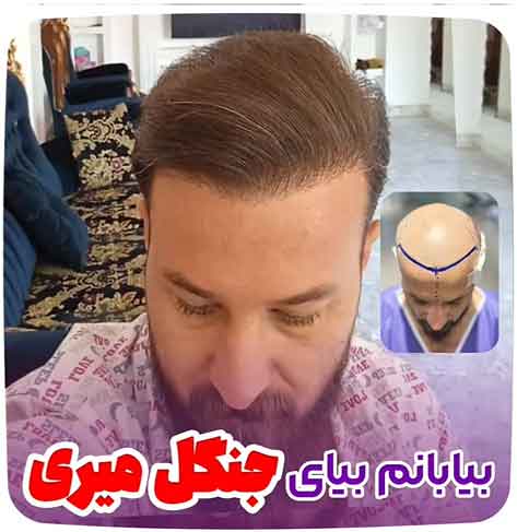 کاشت-مو-45