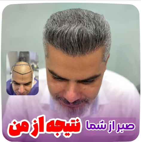 کاشت-مو-46
