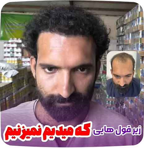 کاشت-مو-48