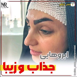 کاشت-ابرو-4