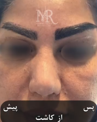 کاشت-ابرو-6