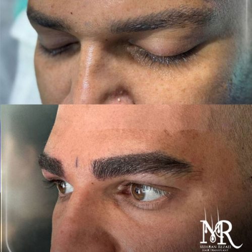 eyebrow-transplant-11