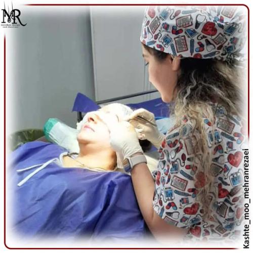 کاشت-ابرو-2