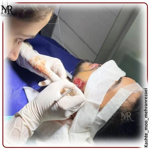 کاشت-ریش-2