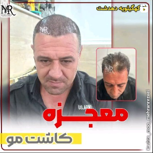 کاشت-مو-28