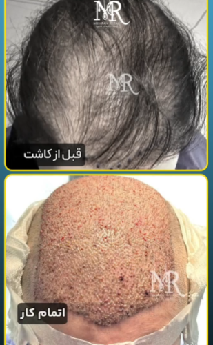 کاشت-مو-30