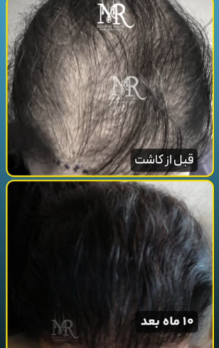کاشت-مو-31