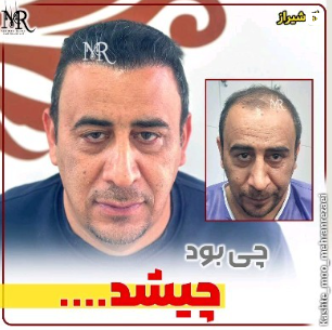 کاشت-مو-32