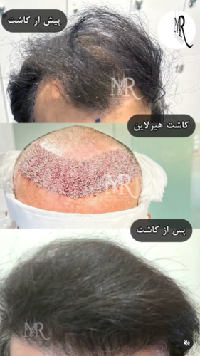 کاشت-مو-29