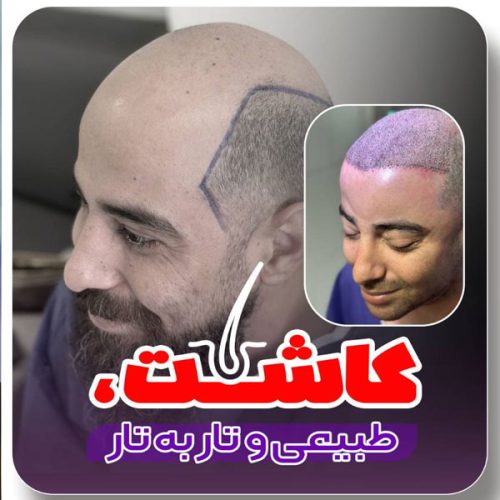 hair-transplant-27