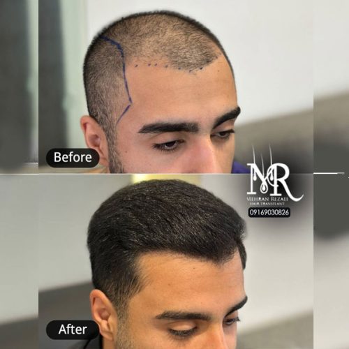 hair-transplant-28
