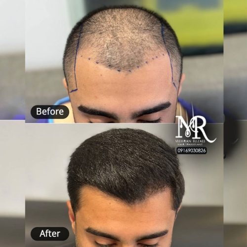 hair-transplant-29