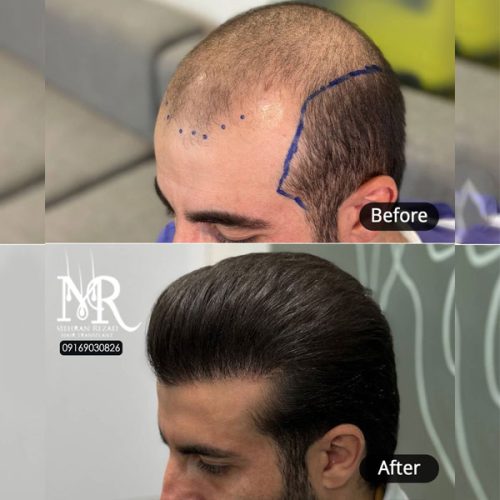 hair-transplant-30