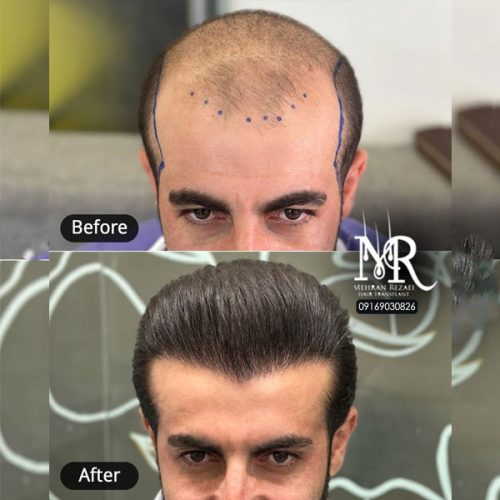 hair-transplant-31
