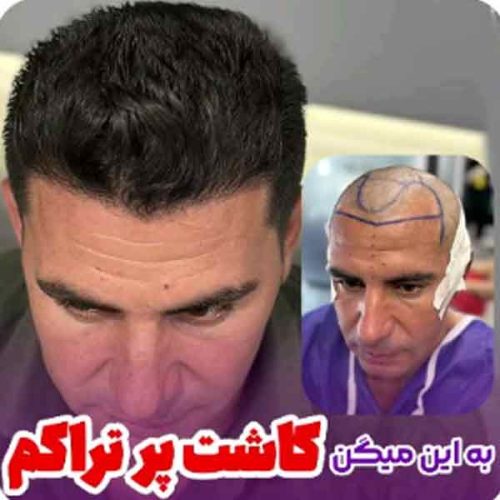 hair-transplant