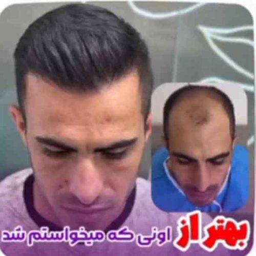 hair-transplant1