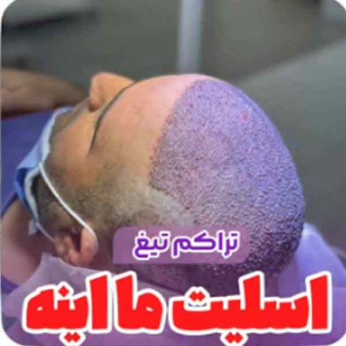 hair-transplant2