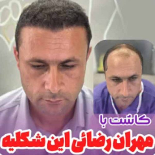 hair-transplant25